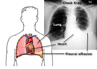 Pleural effusion